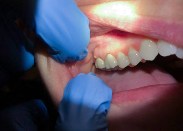 Best Emergency Dental Care for Broken or Chipped Teeth in Rockport, IN